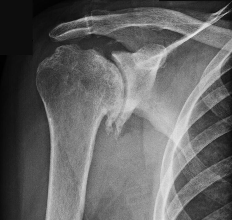 X-ray shows shoulder osteoarthritis