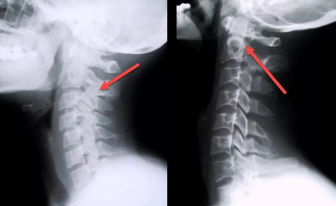 Diagnosis of cervical spondylosis