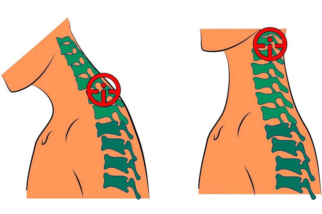 cervical spondylosis