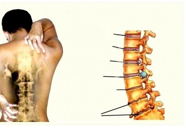 Cervical bone stage