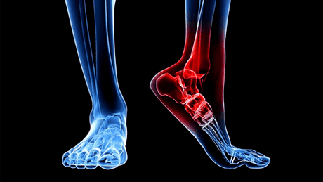 Arthrosis of ankle joints