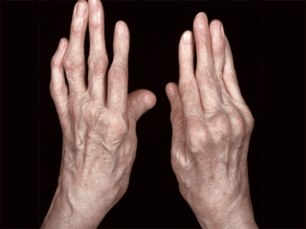 Arthritis is the cause of pain in the joints