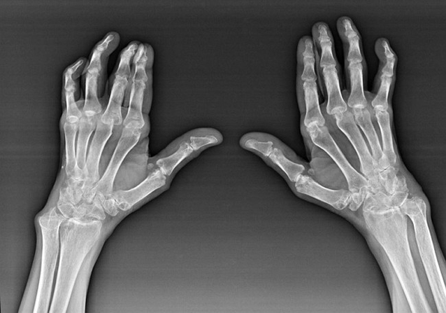 Diagnosis of finger joints