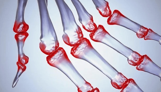 Pain in the joints