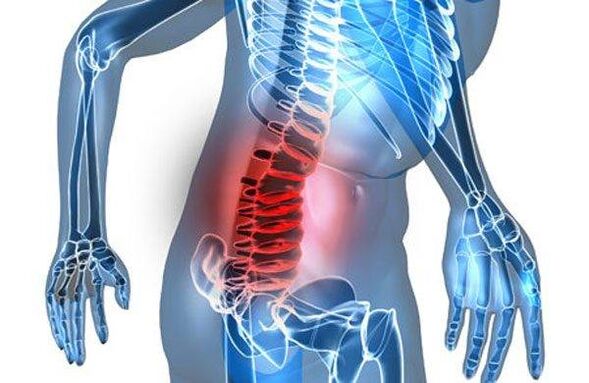 Spinal deformity in the fourth stage of lumbar spondylosis
