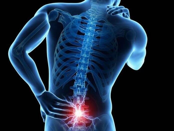 When radiculitis occurs, nerve roots are compressed, causing sharp pain in the lower back