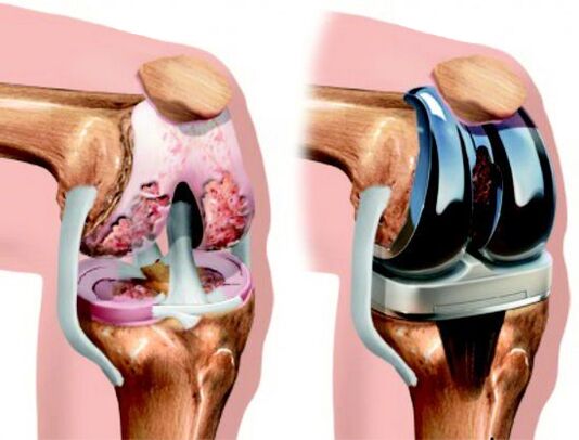 Arthroscopic replacement is a surgical treatment in which the affected joint is replaced with a prosthetic joint.