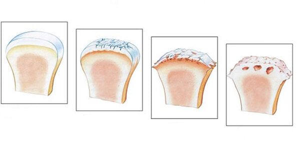 Healthy joints and 3 levels of osteoarthritis development