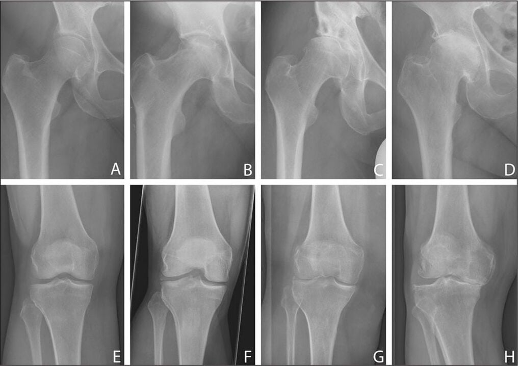 Stages of development of arthritis on X-ray