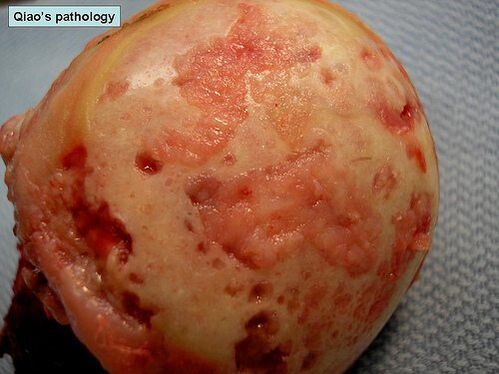 The cartilage surface is affected by arthritis