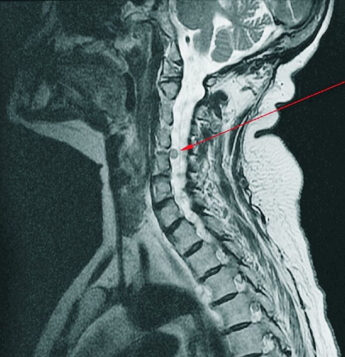Cervical spinal disc herniation on MRI