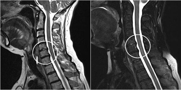 MRI of the cervical spine showed signs of osteochondrosis
